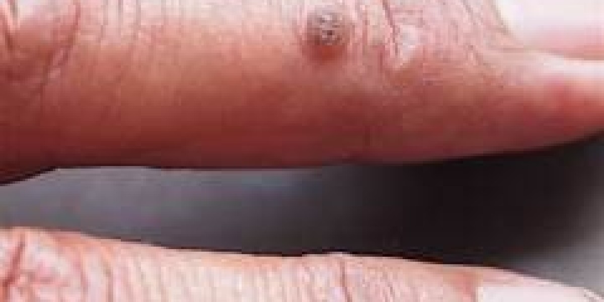 Everything You Need to Know About Common Warts on Skin