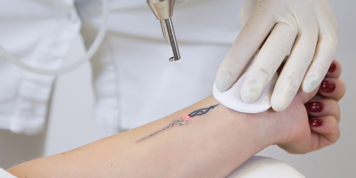 Laser Tattoo Removal FAQs Answered by Skin Experts