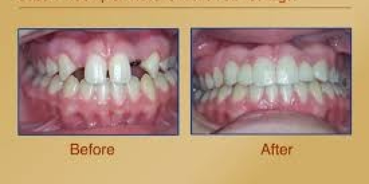 Why Dental Crowns Are the Best Option for Protecting and Restoring Damaged Teeth