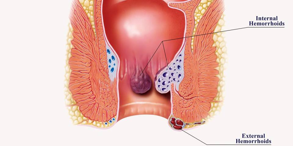 Best Piles Doctor in Bangalore | Dr. Bhushan Chittawadagi- Best Gastroenterologist in Bangalore