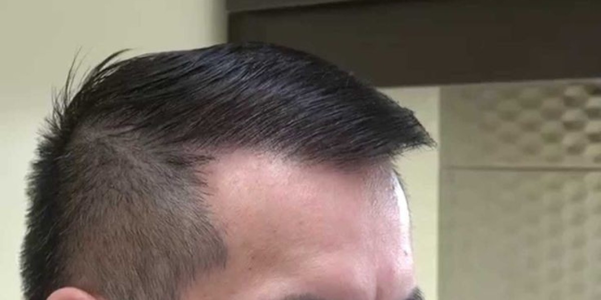 Hair Transplant Abu Dhabi Graft Survival Full Guide