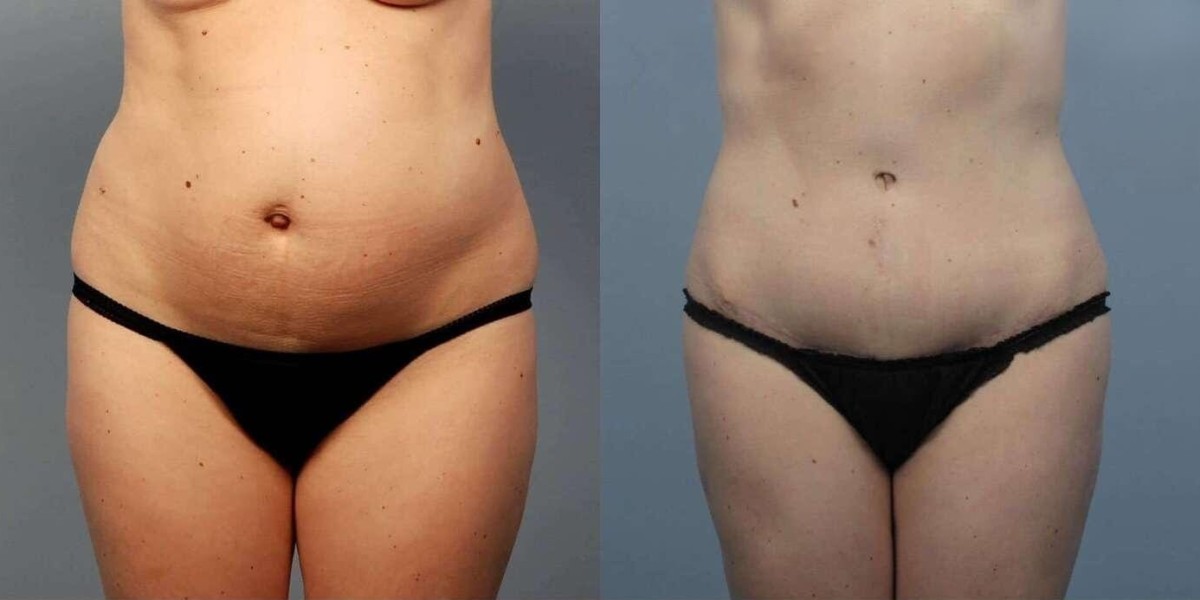 Customizing Your Transformation Tailored BodyTite Plans in Riyadh