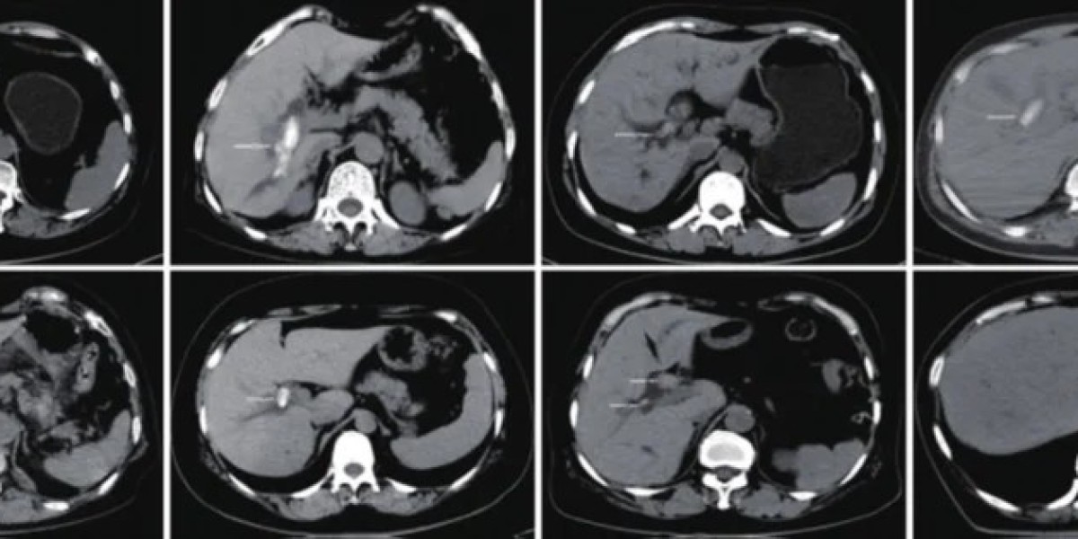 Electrohydraulic Lithotripsy: An Innovative Approach to Minimally Invasive Treatment of Liver and Bile Duct Stones