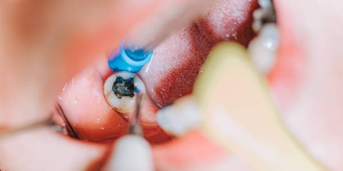 Dental Filling in Pakistan – Restore Tooth Strength with Modern Dentistry