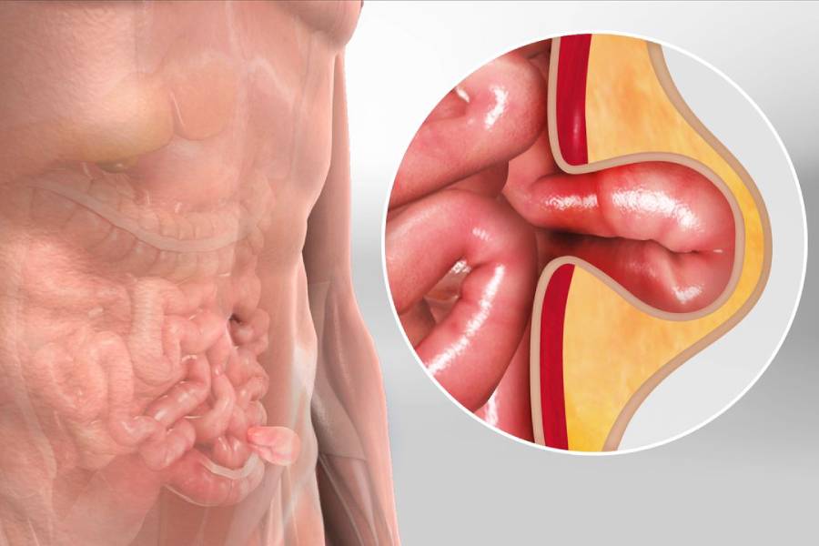 Hernia specialist in Chennai | Dr. S. Srivatsan Gurumurthy - Gastroenterologist in Chennai