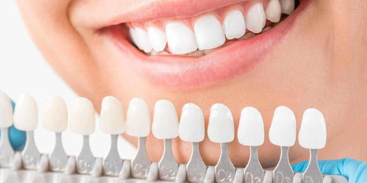 Cost Factors for Veneers Dubai Treatments