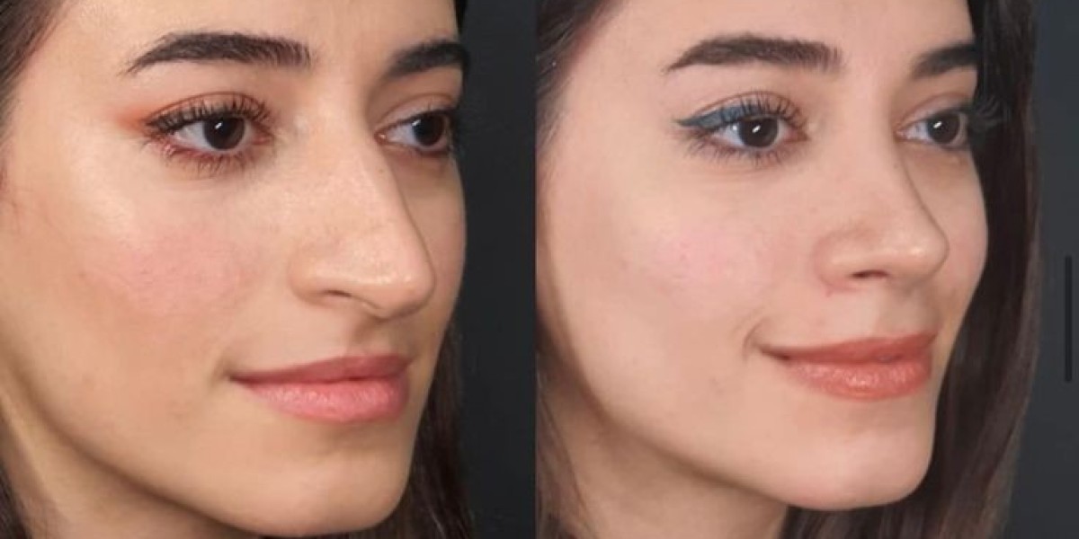 Rhinoplasty Surgery in Dubai Cosmetic Solutions Guide