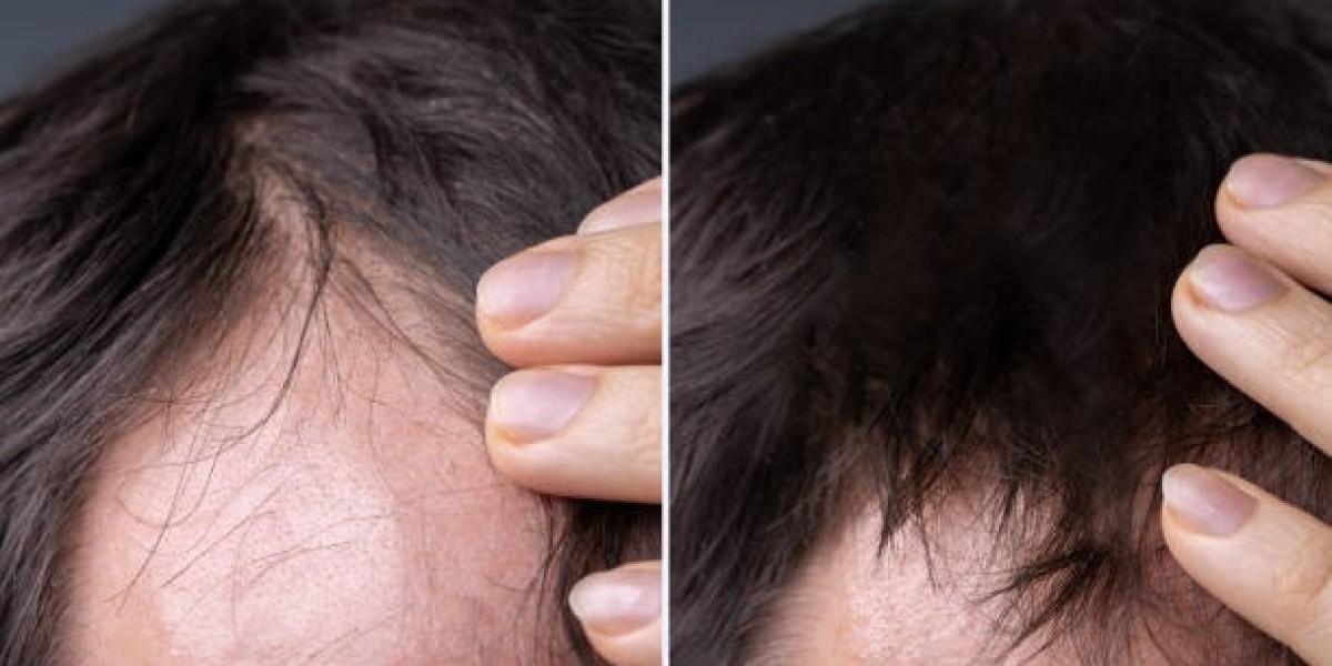 Advanced Hair Restoration Treatments for Long-Term Results