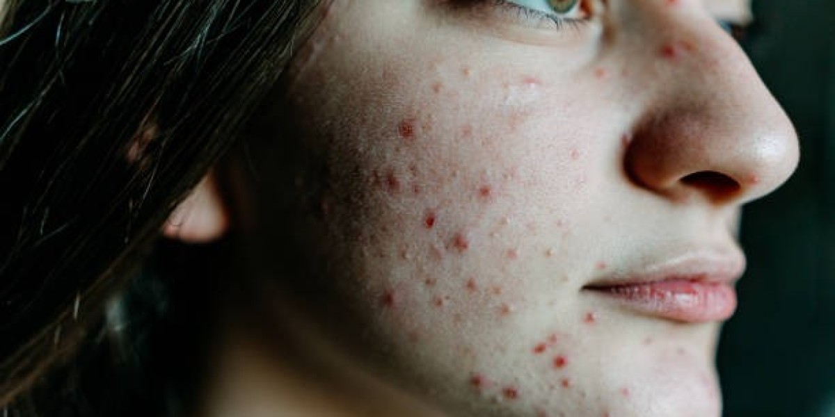 Mild vs. Severe Acne Scar Treatment in Dubai – Protocols