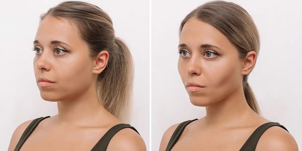 Get Defined Cheeks with Buccal Fat Removal in Islamabad