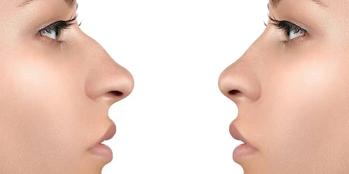 Best Age to Consider Rhinoplasty in Islamabad