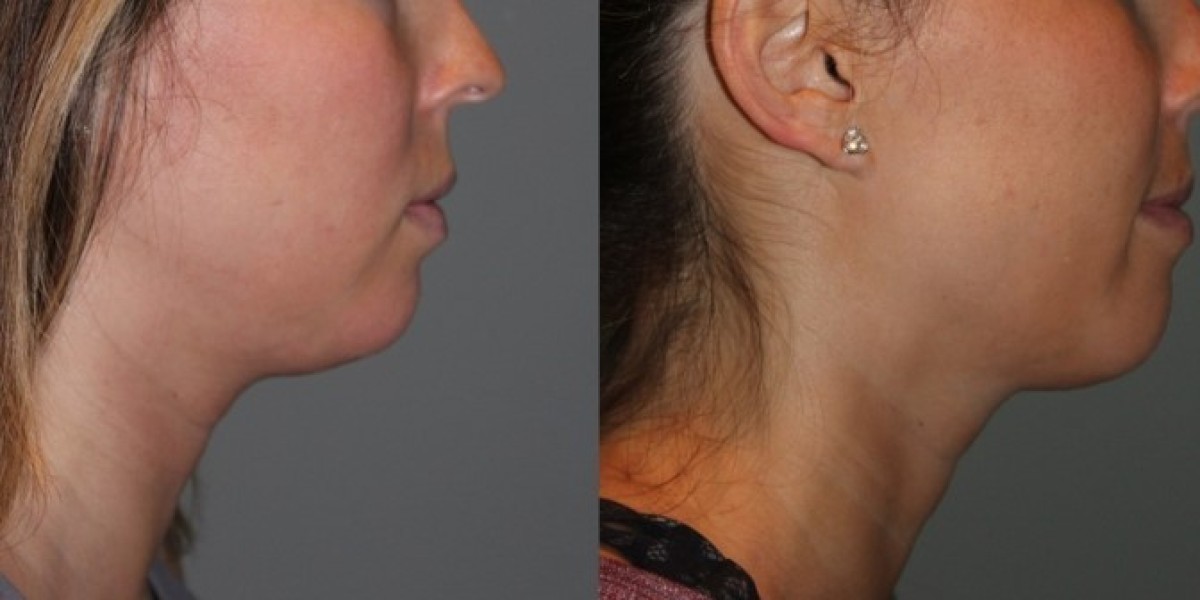 Kybella Treatment for Double Chin in Dubai Results Expectations