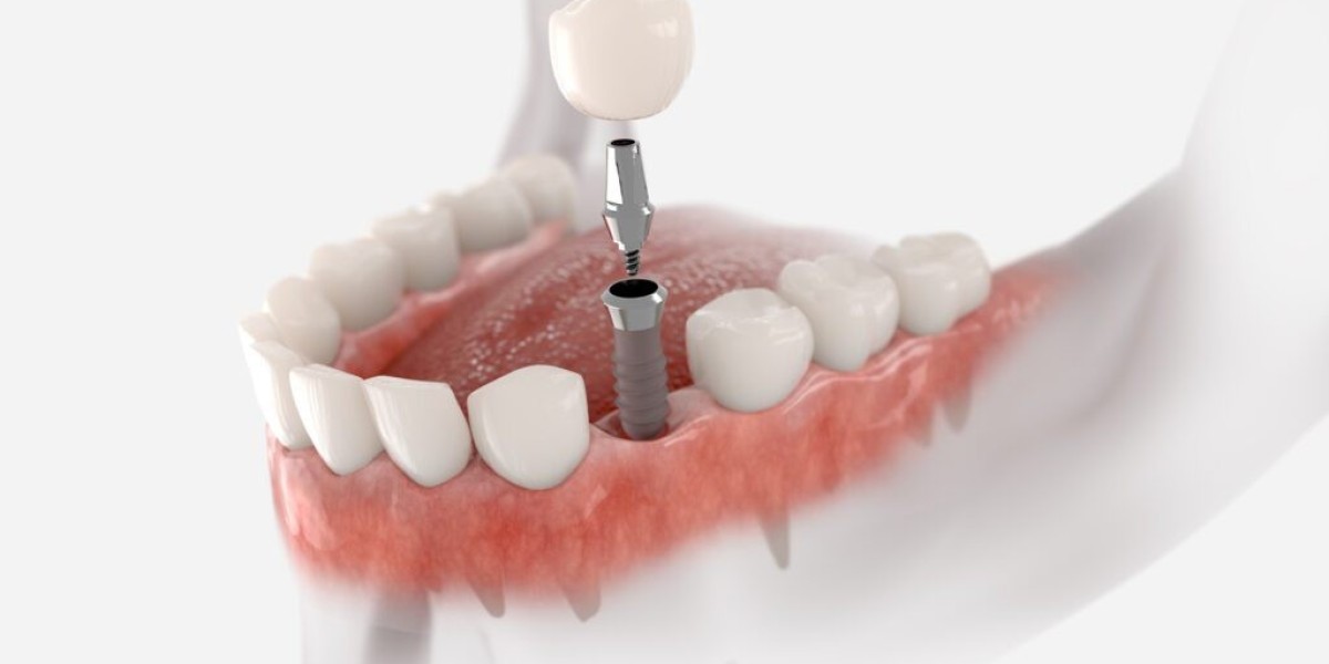 Dental Implant: A Long-Lasting Solution to Missing Teeth