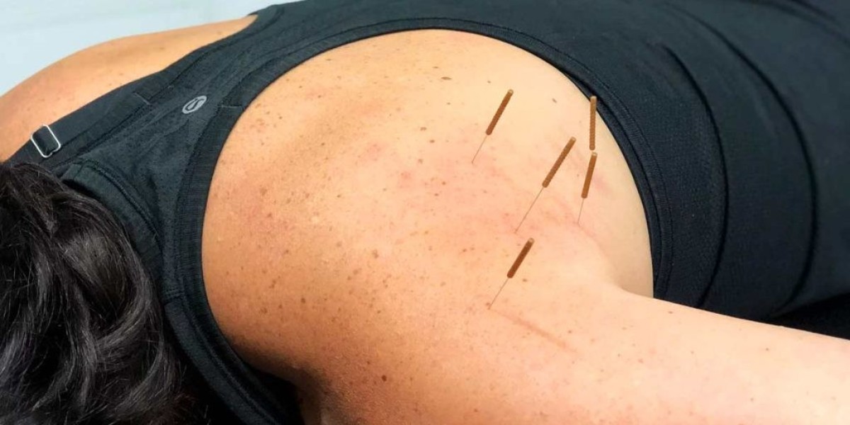 How Dry Needling in Dubai Can Relieve Muscle Pain: Exploring Trigger Point Therapy and Sports Physiotherapy Options
