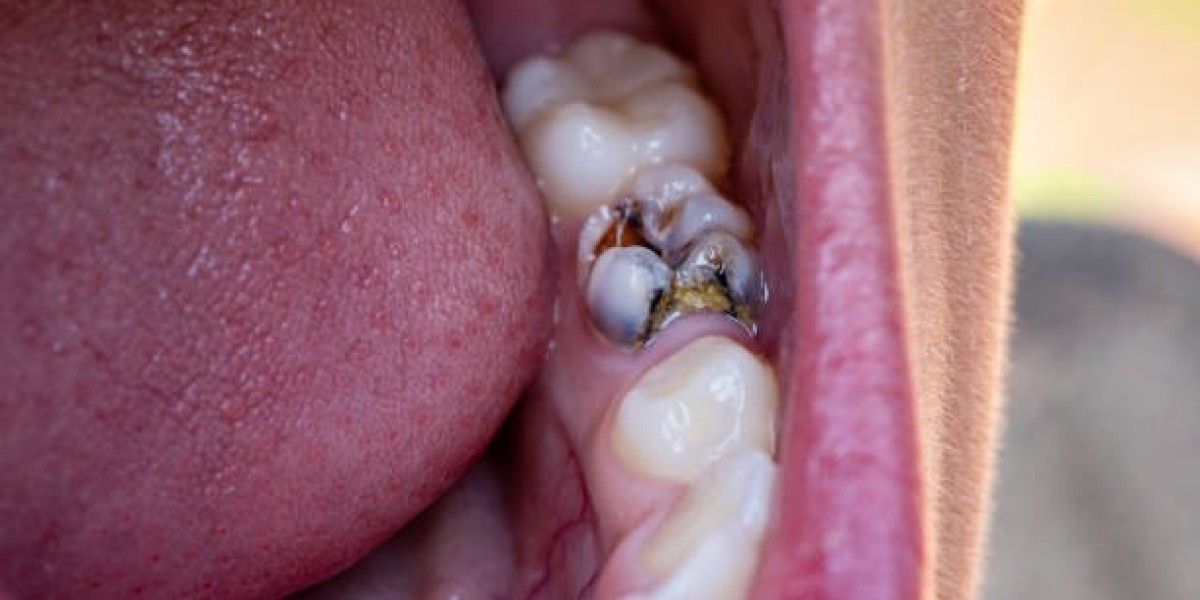 A Reliable Way to Save Your Natural Tooth Root Canal Treatment in Islamabad Pakistan: