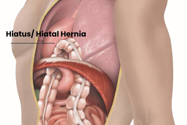 Hiatal Hernia Treatment in Chennai | Dr. S. Srivatsan Gurumurthy - Hernia specialist in Chennai