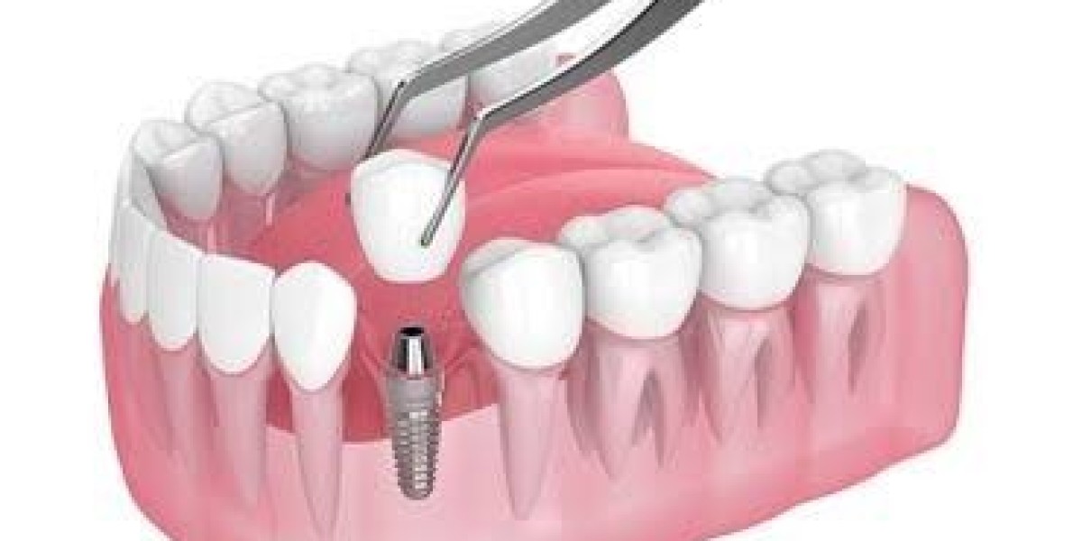 Treatment of Fractured Teeth in Dubai: Everything You Need to Know for a Healthier Smile