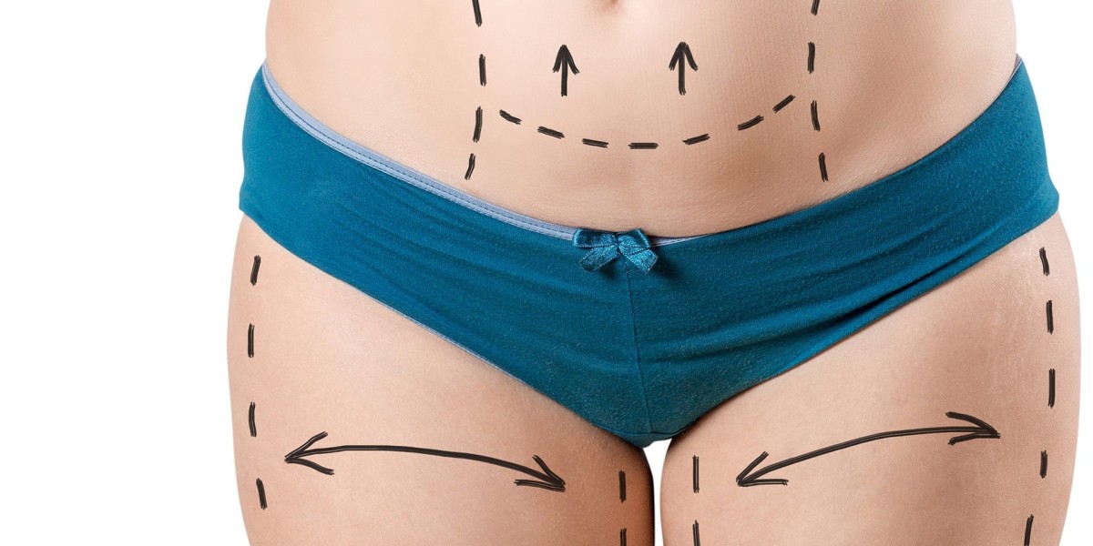 Liposuction in Islamabad and the Importance of Body Symmetry