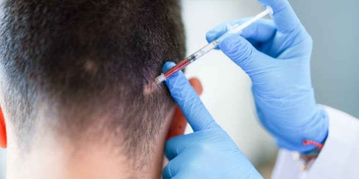 What Results to Expect and When PRP Hair Treatment in Islamabad: