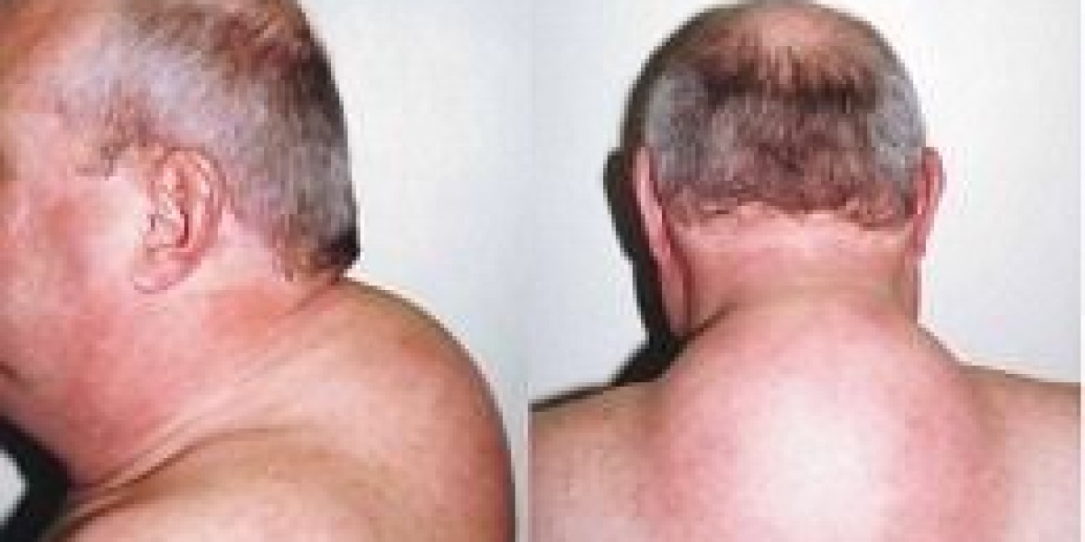 Buffalo Hump Removal in Dubai: How It Helps Improve Body Shape and Confidence