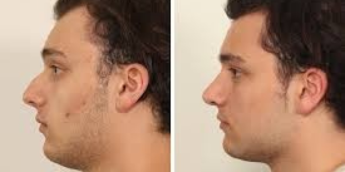 Rhinoplasty in Dubai Male Nose Job Trends