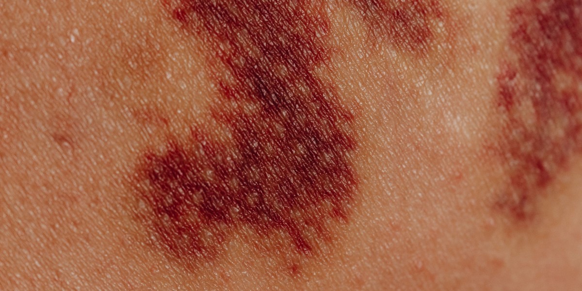 Idiopathic Thrombocytopenic Purpura Therapeutics Market Outlook Advancements in Treatment Solutions