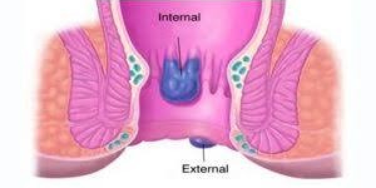 Modern Approaches to Hemorrhoid Treatment in Dubai for Lasting Relief