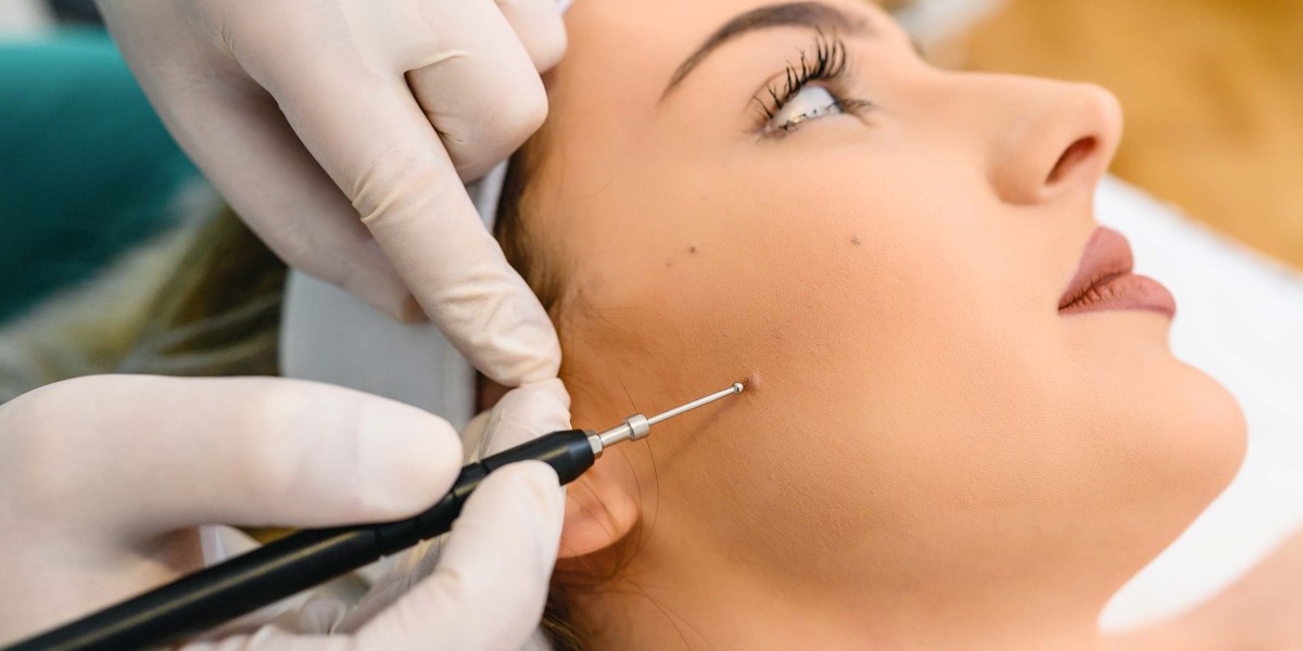 Mole Removal in London: Surgical Excision vs. Laser Treatment Explained
