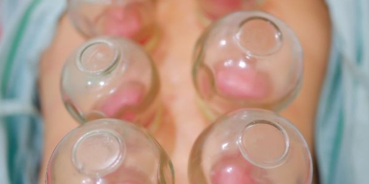 Benefits of Cupping Therapy on Back for Improved Blood Circulation and Recovery