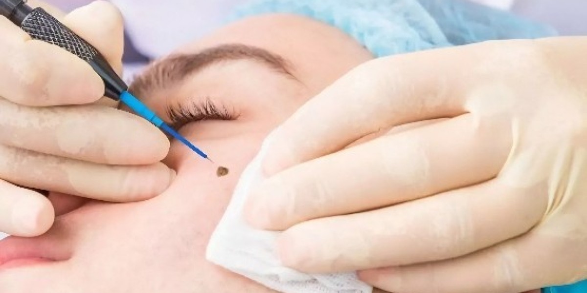Mole Removal in Dubai: Step-by-Step Process Guide