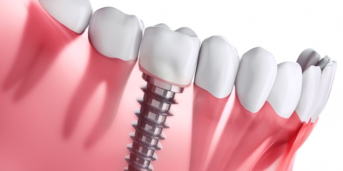 The Advanced Science of Dental Implants and Modern Implantation Dentistry