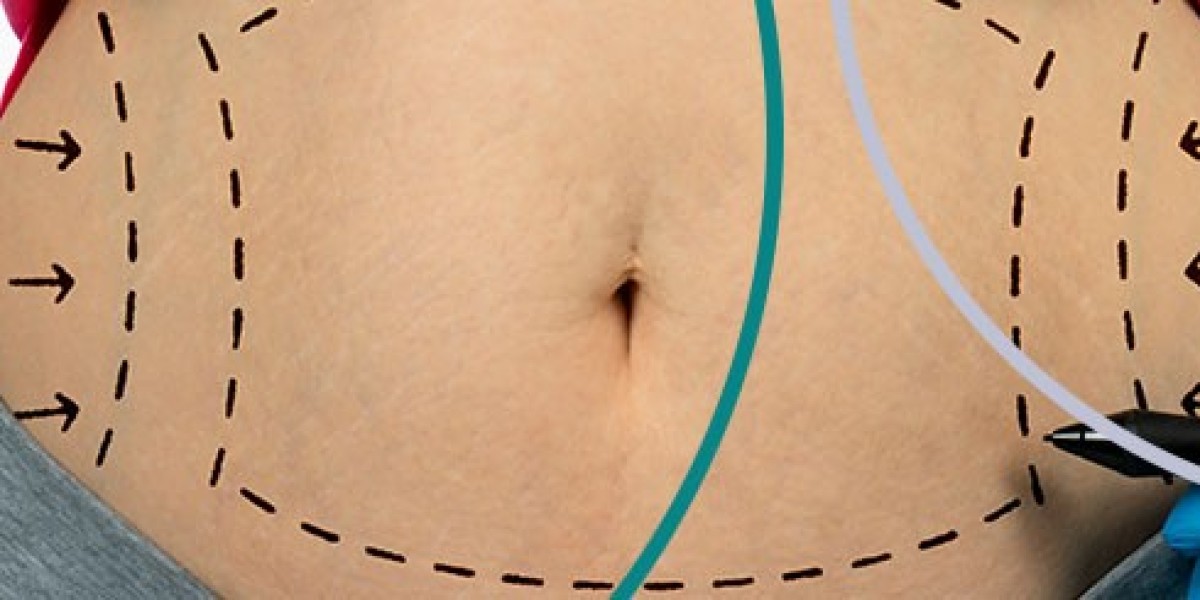 Liposuction in Riyadh: A Trusted Option for Fat Reduction