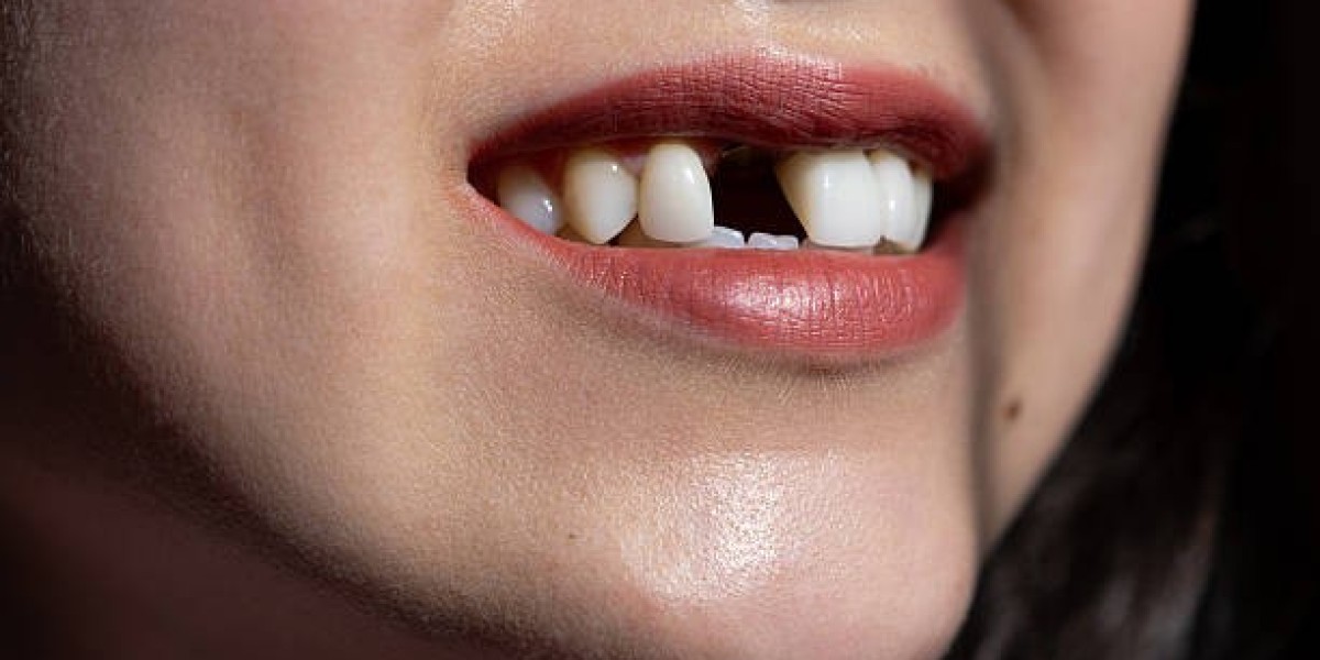 Restore Damaged Teeth Before Complications Develop Tooth Fracture Treatment in Pakistan: