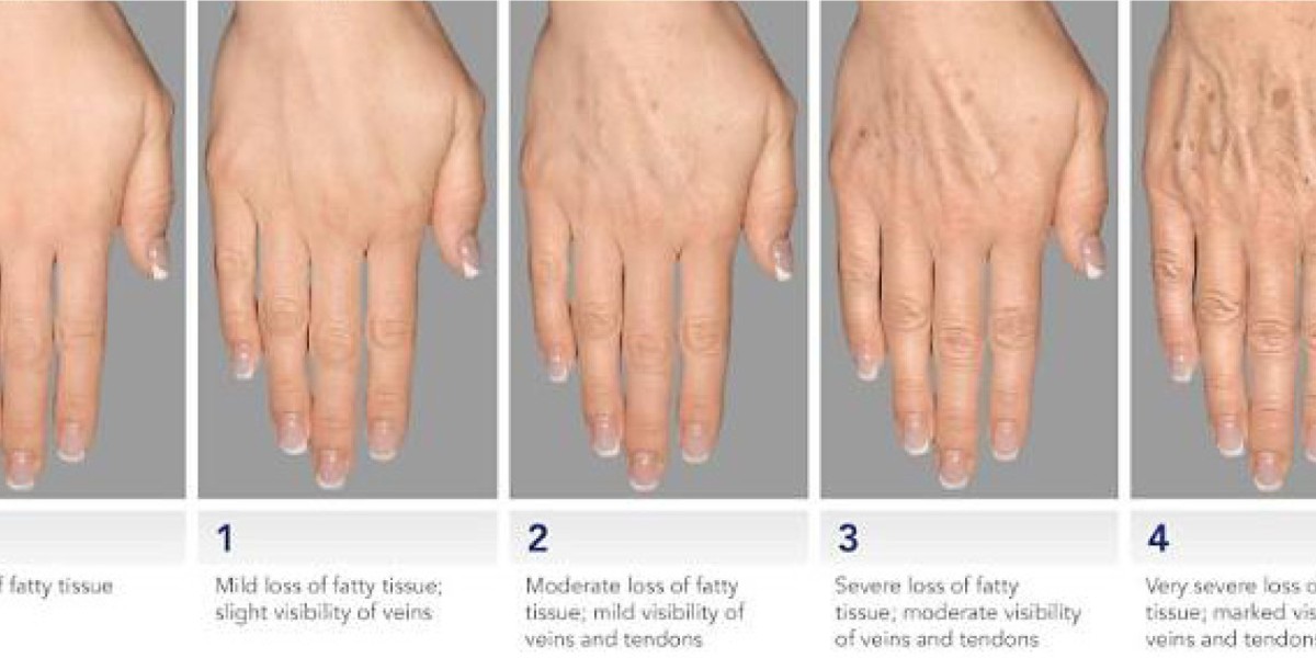 Minimizing Downtime After Hand Rejuvenation Treatments