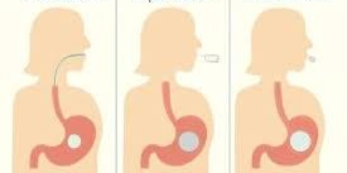 MedCell Laparoscopic Balloon in Dubai: How It Supports Modern Weight Loss Goals