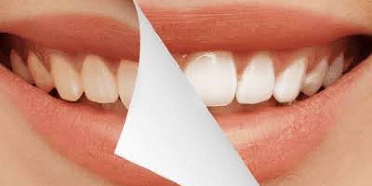 Zoom Teeth Whitening in Dubai: Achieve a Brighter and More Confident Smile