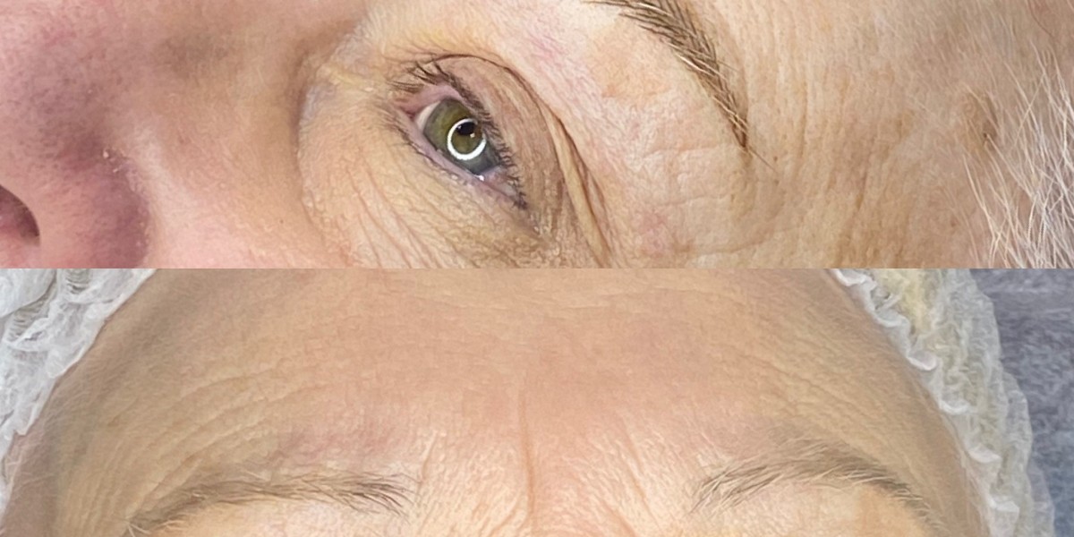 Understanding Laser Tattoo Removal and Why More People Are Choosing It
