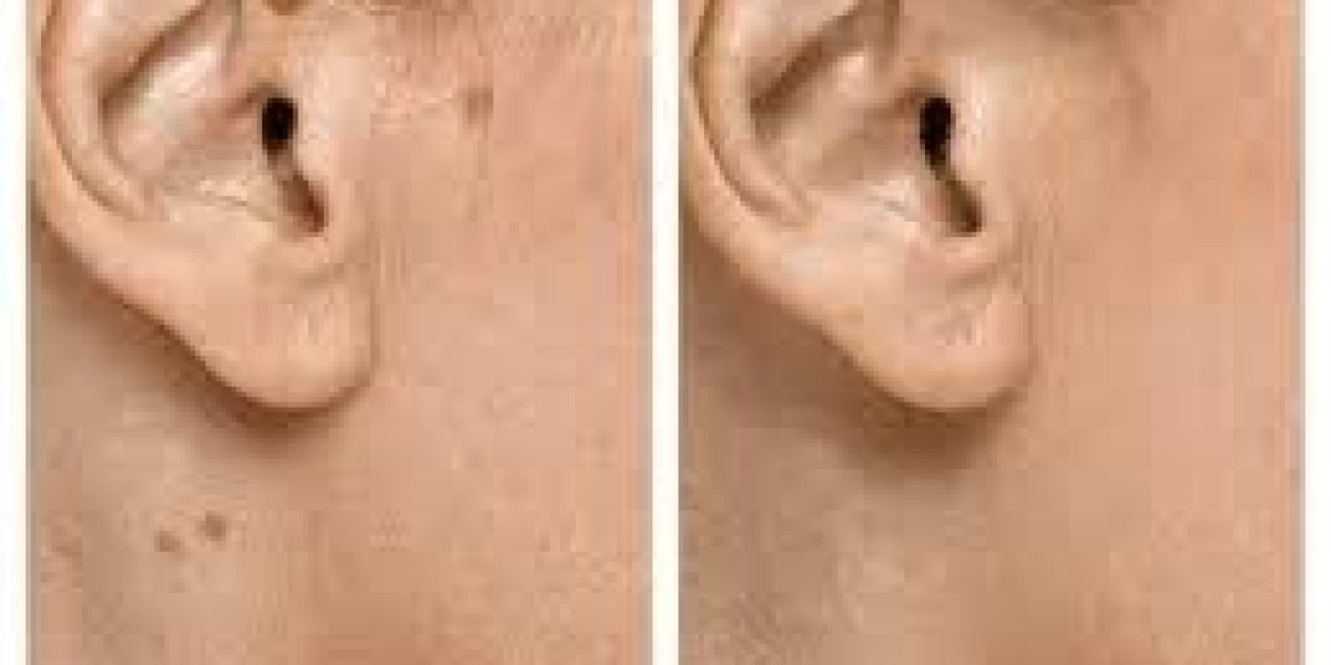 Complete Guide to Seborrheic Keratosis Treatment in Dubai