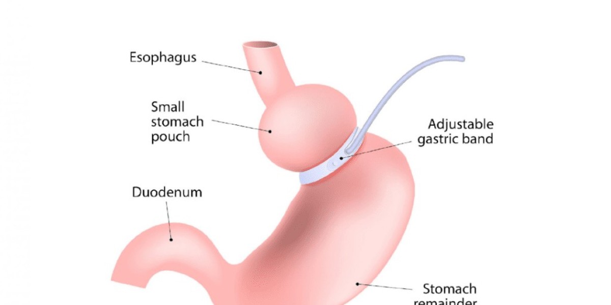Gastric Banding Recovery Tips for Faster Healing