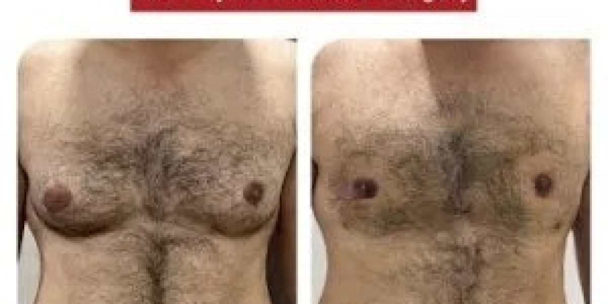 How Long Does Gynecomastia Surgery Take?