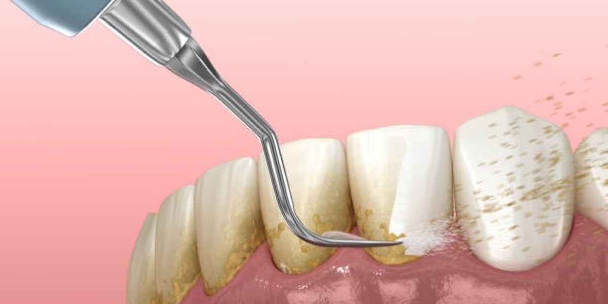 The Importance of Teeth Scaling and Polishing for Preventing Gum Problems