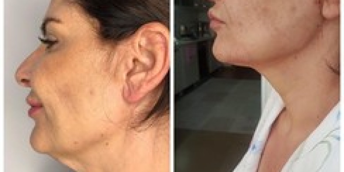 8-Point Facelift In Dubai For Long-Lasting Results