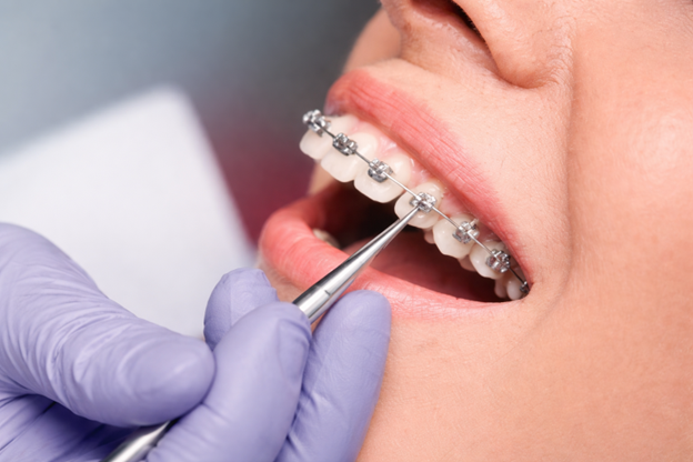 تبدأ رحلتك نحو أسنان مثالية مع أخصائي تقويم الأسنان المناسب في أبوظبي - Hollywood Smile Medical Center