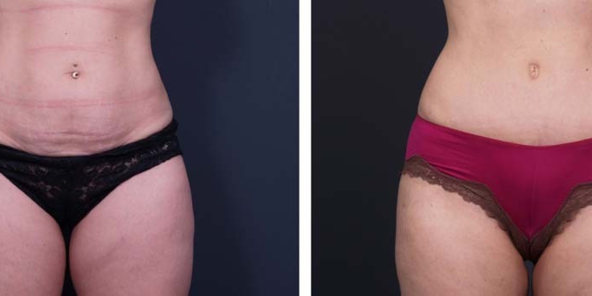 Tummy Tuck Surgery in Dubai for Weight Loss Support