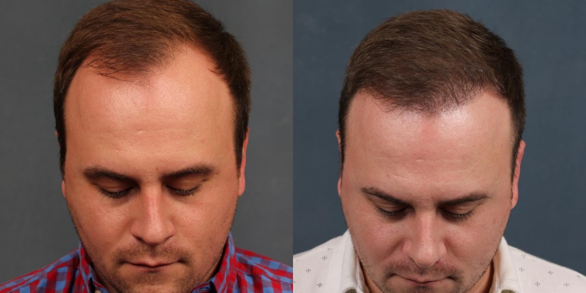 Hair Transplant In Dubai Healing Process Timeline Guide
