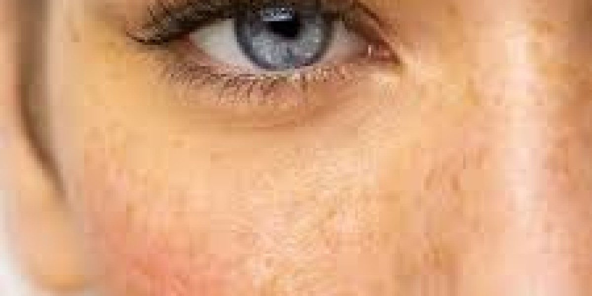 Skin Pigmentation Treatment in Dubai: Complete Guide to Even Skin Tone