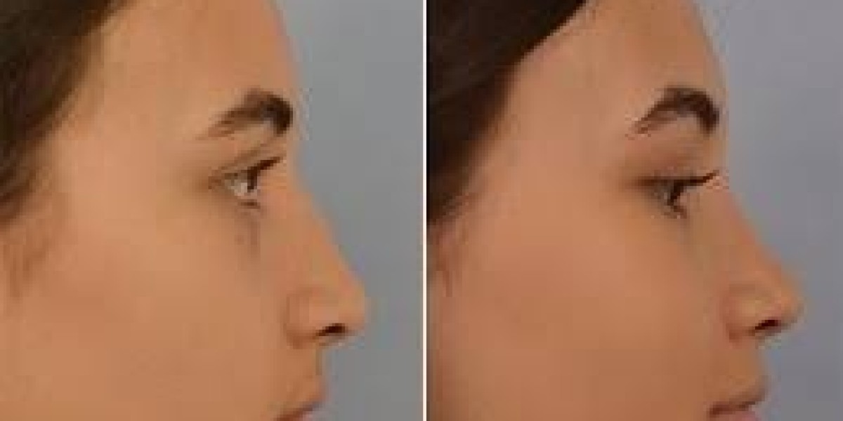 Rhinoplasty in Dubai: A Complete Guide to Achieving Facial Harmony