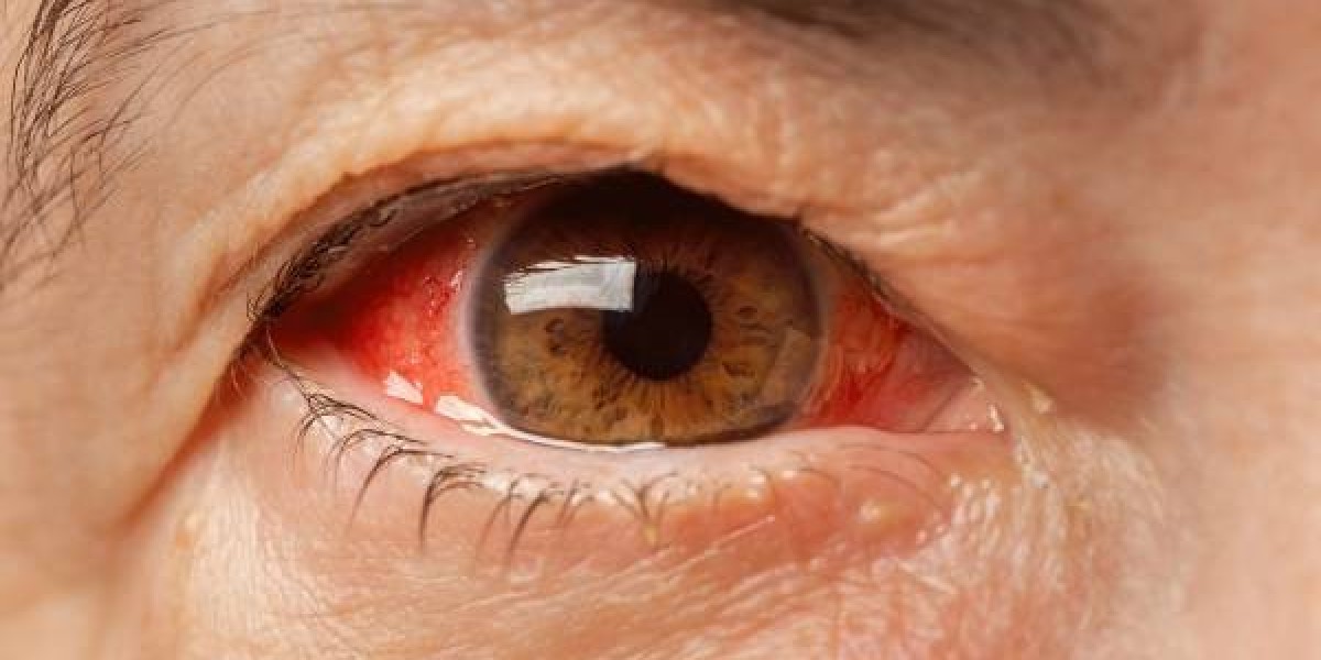 Glaucoma Treatment in Wakad: Protect Your Vision with Early Diagnosis and Expert Care