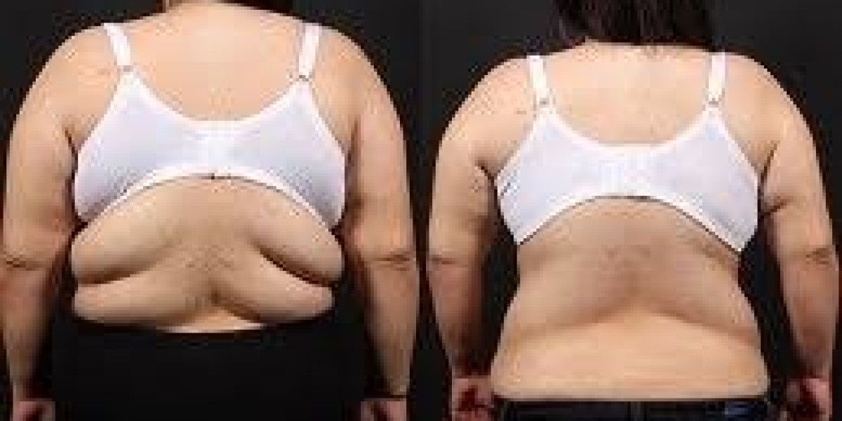 Back Lift in Dubai | Restore a Smooth and Contoured Back