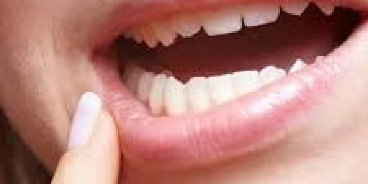 Treatment of Fractured Teeth in Dubai: Complete Guide to Restoring Your Smile